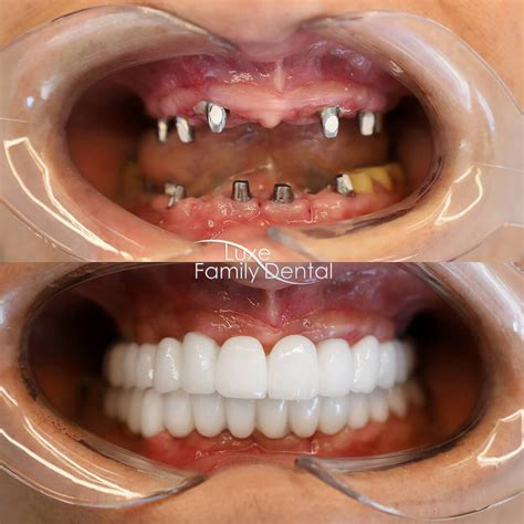 same day teeth in ashford|All On 4 Same Day Dental Implants .